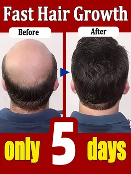 Средства для роста волос Масло для быстрого роста волос Эффективное средство от облысения Наследственное выпадение Волос Себорейное Средство против выпадения волос